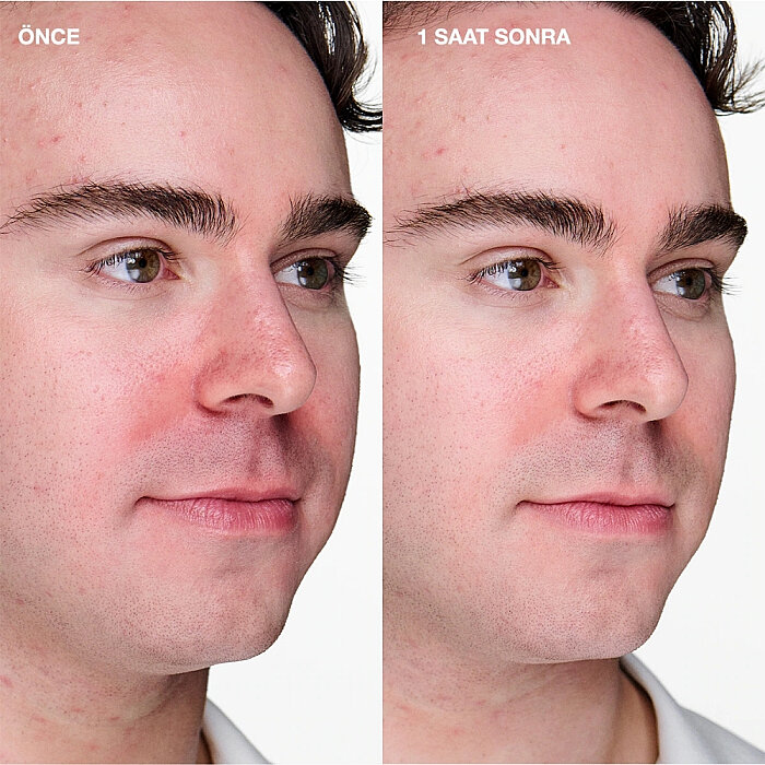 Clinique Anti Blemish Clinical Sivilce Karşıtı Jel 20 Ml - 2